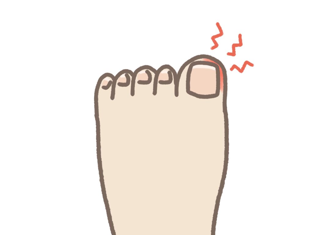 巻き爪で痛みが出ている足のイラスト