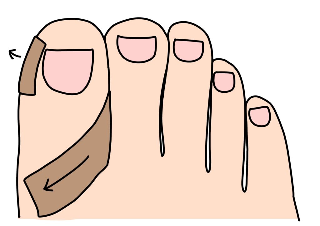 巻き爪の応急処置としてテーピングで皮膚を引き下げている足のイラスト