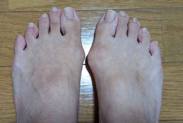 外反母趾の症状がある両足の写真｜親指の付け根が出っ張って見える状態