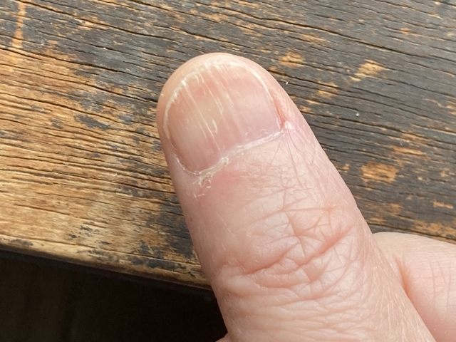 足の爪の健康状態を確認するための写真。爪の色・形・表面の状態がわかる。